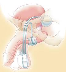 Reconstrução Uretral